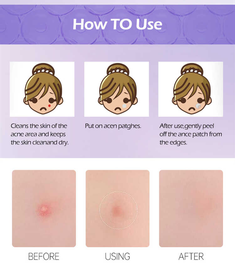 Acne Patch(图7)