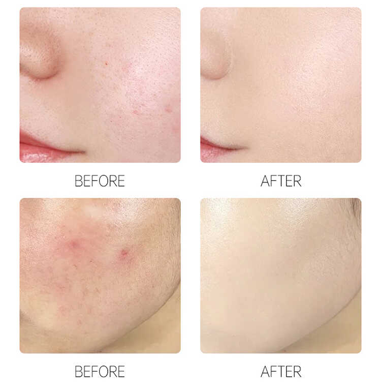 Acne Patch(图8)