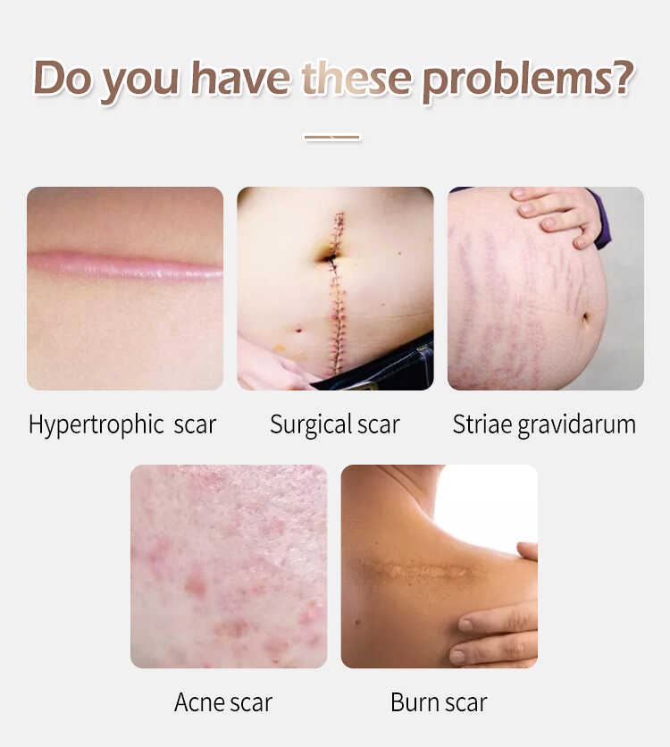 Silicone Scar Sheets(图2)
